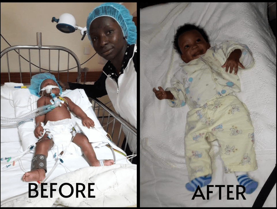 Before and after: the baby on a ventilator in intensive care, and healthy months later